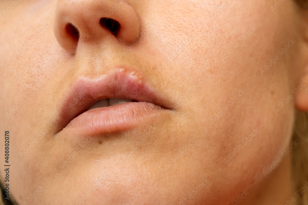 Cold sore on the lip of woman Cold sore on the lip of woman