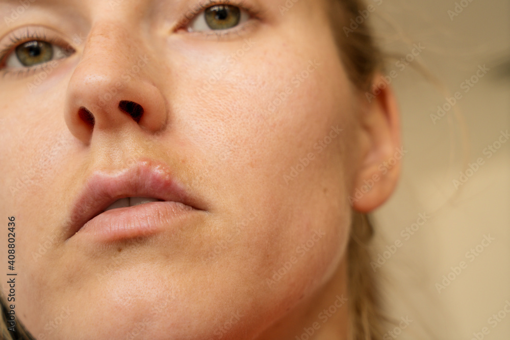 Cold sore on the lip of woman Cold sore on the lip of woman