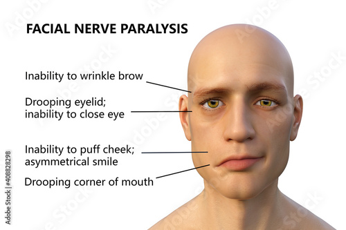 Facial nerve paralysis photo