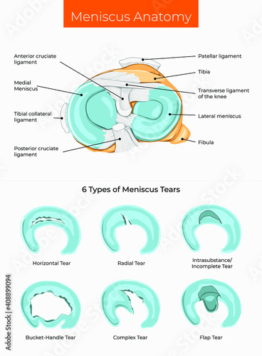 Vector illustration. Meniscus Anatomy and 6 Types of Meniscus Tears.