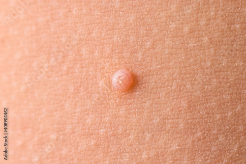 Detail of a molluscum contagiosum nodule produced by the Molluscipoxvirus virus on the skin of the abdomen of a child. photo