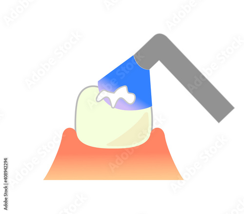 illustrations of dental sealants treatment before after