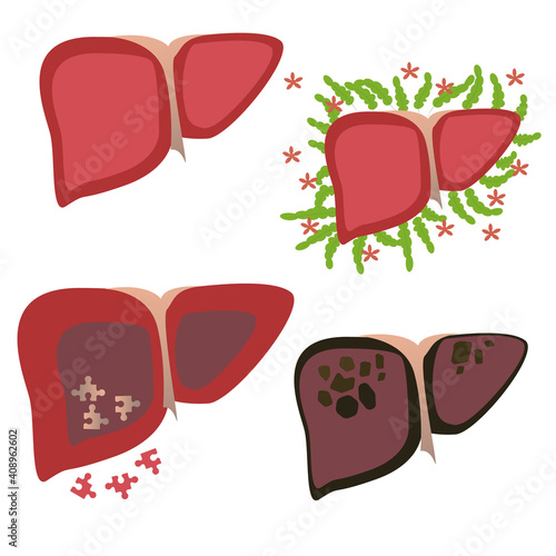 Healthy and diseased human liver. From healthy, fatty liver, fibrosis, cirrhosis to liver cancer. Medical infographics, liver disease icons in flat design isolated on white background.