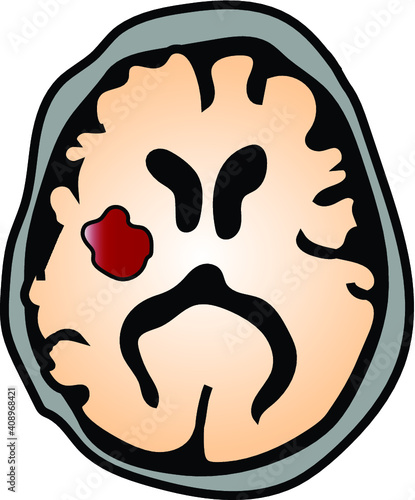 illustration of axial cut of brain with intracerebral hemorrhage