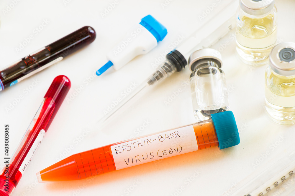Mononucleosis and Epstein-barr virus blood test sample in lab on the white background Mononucleosis and Epstein-barr virus blood test sample in lab on the white background