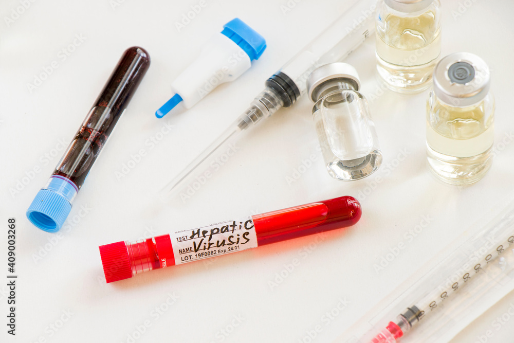 Hepatitis C blood test tube samples in laboratory, Hepatitis C vaccine Hepatitis C blood test tube samples in laboratory, Hepatitis C vaccine