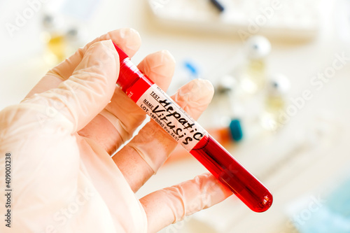 Hepatitis C blood test tube samples in laboratory, Hepatitis C vaccine photo