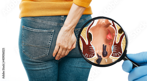 Doctor's hand with a magnifying shows the pathologies of rectum and hemorrhoids. Woman with hemorrhoid disease on background photo