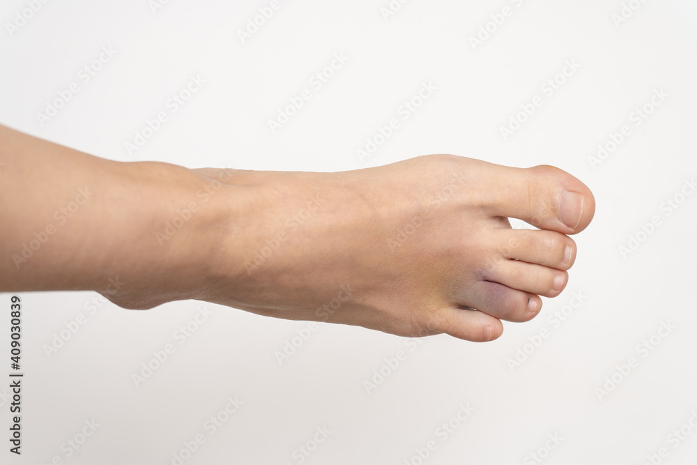 Bruise on the foot. Hematoma after injury to the ring toe of the left foot. Female injured limb on a white background. Bruise on the foot. Hematoma after injury to the ring toe of the left foot. Female injured limb on a white background.