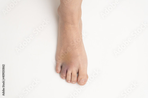 Bruise on the foot. Hematoma after injury to the ring toe of the left foot. Female injured limb on a white background.