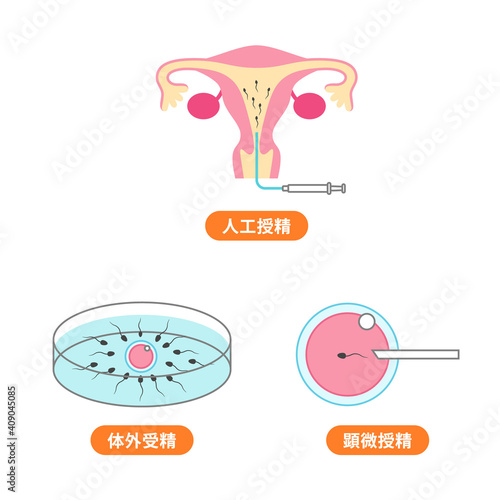 人工授精、体外受精、顕微授精のイラスト