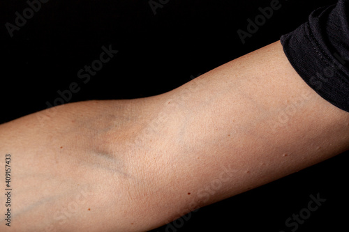 Close up image of a caucasian woman s elbow section  ventral side  with forearm extended and arm at lateral rotation. Background is black cephalic and basilic veins are visible.