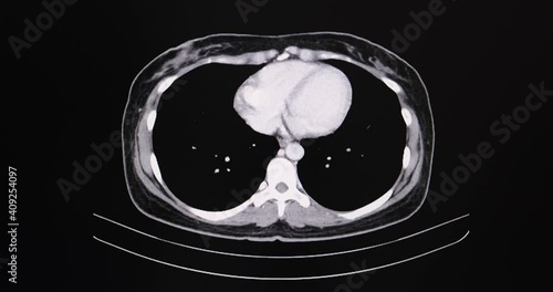 A motion CT scan of a female patient with large ovarian tumor. photo