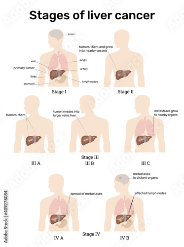 Liver cancer stages with a brief description of each