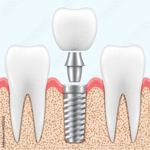 Implantation of tooth process in realistic style. Stomatological restoration, rehabilitation on implant.