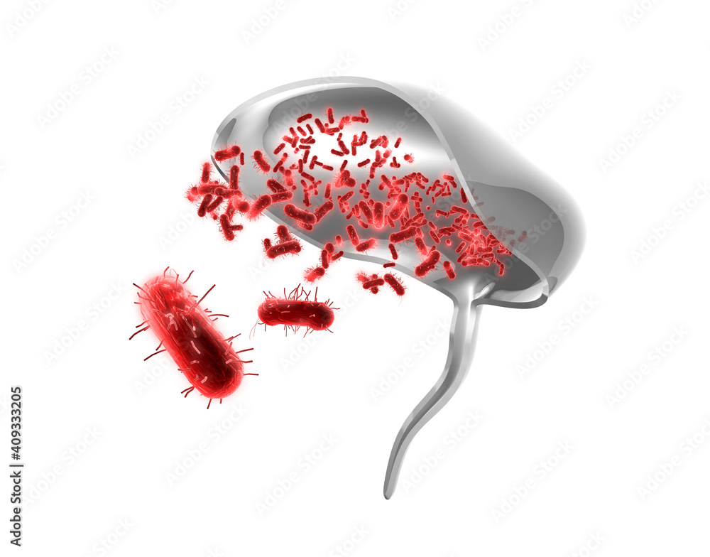 Cross section of the human bladder showing the disease Cystitis. An