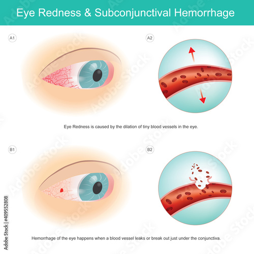 Eye Redness & Subconjunctival Haemorrhage. Eye Redness is caused by the dilation of tiny blood vessels in the eye.