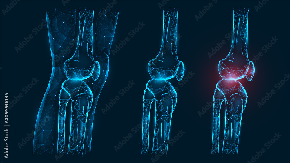 Polygonal vector illustration thigh and knee joint side view. Disease, pain, and inflammation of the knee joint. Low poly model of a healthy and injured human knee on a dark blue background - obrazy, fototapety, plakaty 