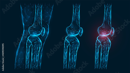 Polygonal vector illustration thigh and knee joint side view. Disease, pain, and inflammation of the knee joint. Low poly model of a healthy and injured human knee on a dark blue background