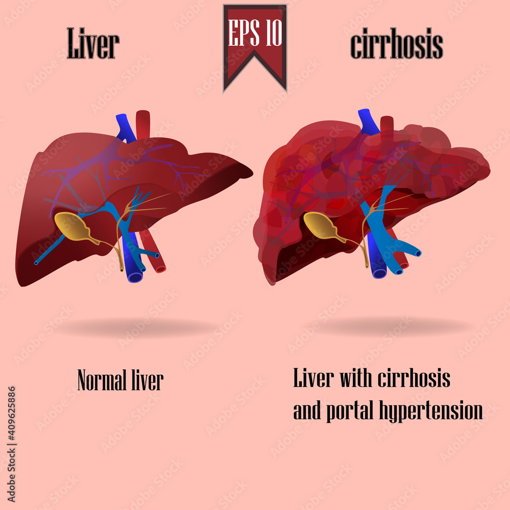 Vector Medical Illustration Of Normal Liver And Cirrhosis With Portal vector-medical-illustration-of-normal-liver-and-cirrhosis-with-portal