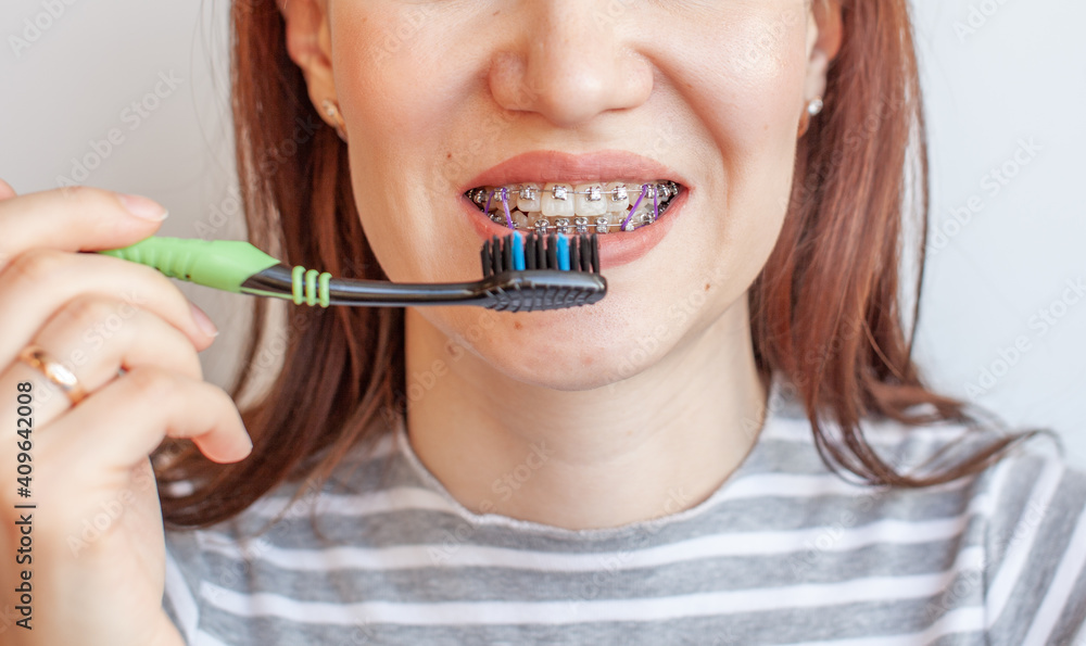 Braces in the smiling mouth of a girl. Smooth teeth from braces. Braces in the smiling mouth of a girl. Smooth teeth from braces.
