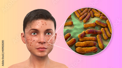 Acne vulgaris and bacteria Cutibacterium acnes photo
