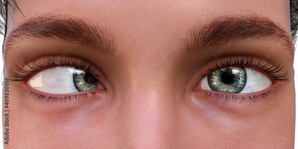 Fototapeta premium Strabismus, eyes deviation, illustration
