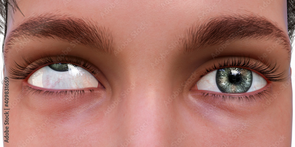 Strabismus, eyes deviation, illustration Strabismus, eyes deviation, illustration