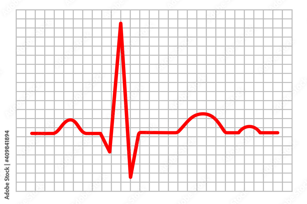 Electrocardiogram - 5 Electrocardiogram - 5
