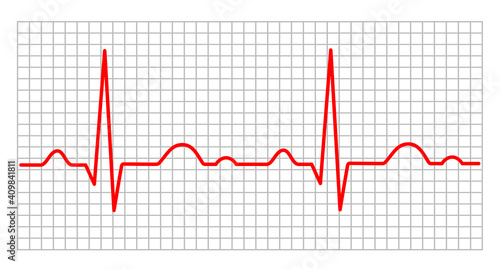 Electrocardiogram - 4