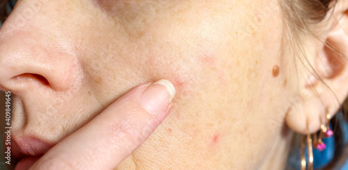 The skin of an older woman with pimples and enlarged pores. Skin care.