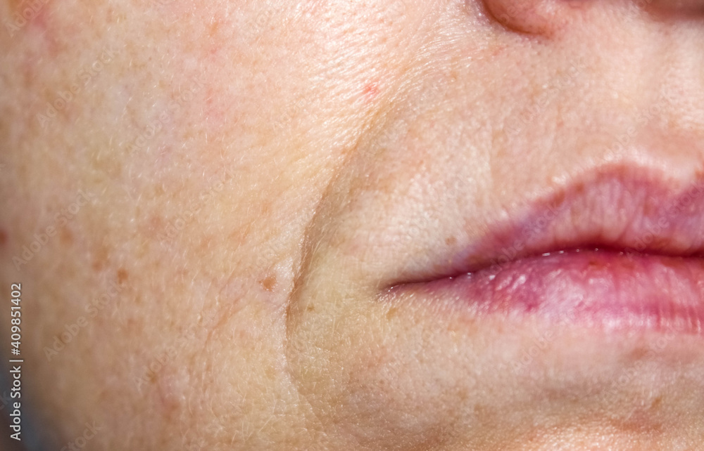 Nasolabial folds and enlarged pores on the female face. Skin care in 40 years. Nasolabial folds and enlarged pores on the female face. Skin care in 40 years.