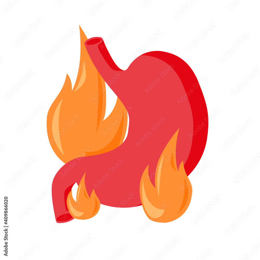 Stomach. Human internal organs. Digestive system anatomy. Heartburn. Gastroesophageal reflux disease. Stomach GERD heartburn esophagus. Vector illustration Stomach. Human internal organs. Digestive system anatomy. Heartburn. Gastroesophageal reflux disease. Stomach GERD heartburn esophagus. Vector illustration