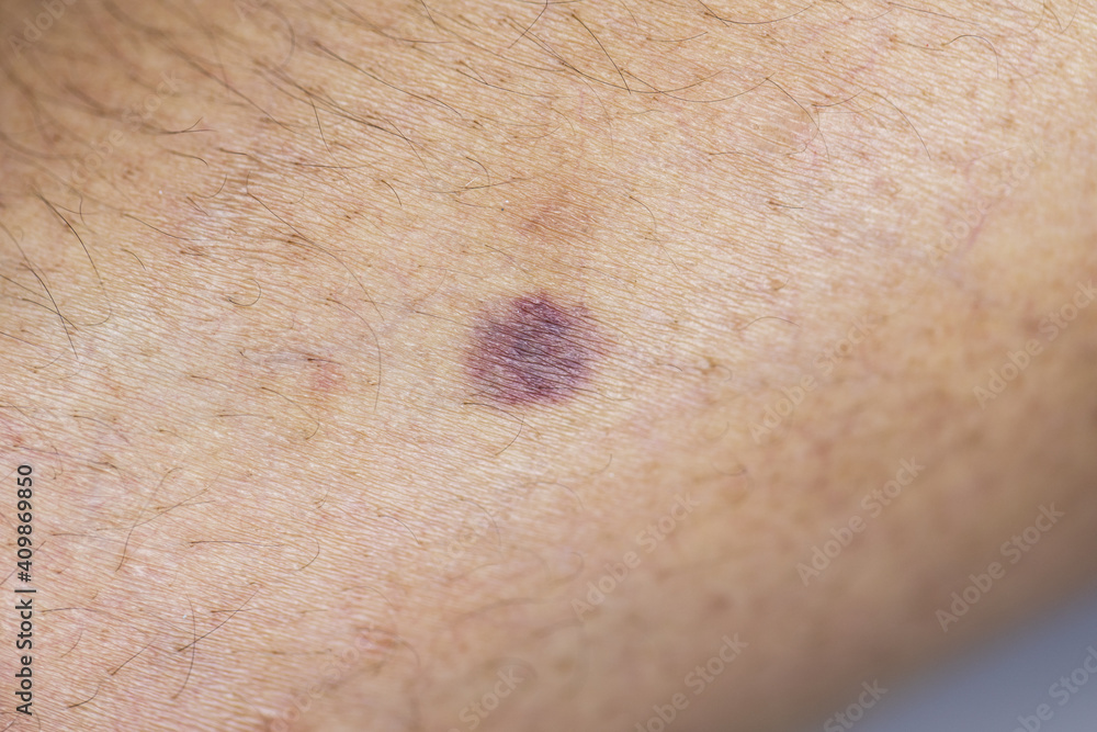 Fototapeta premium The physical appearance of the arm with the wound is caused by Haemophilia, (Haemophiliais a mostly inherited genetic disorder)