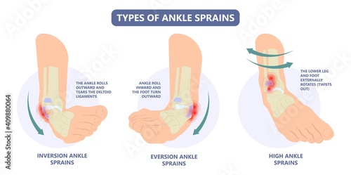 injury Talo Fibular foot treat high low roll twist tear tough bands bone joint range of motion Pain foot broken leg fall jump Walking exercising sport R.I.C.E rice Rest Ice break tendon Grade fibers