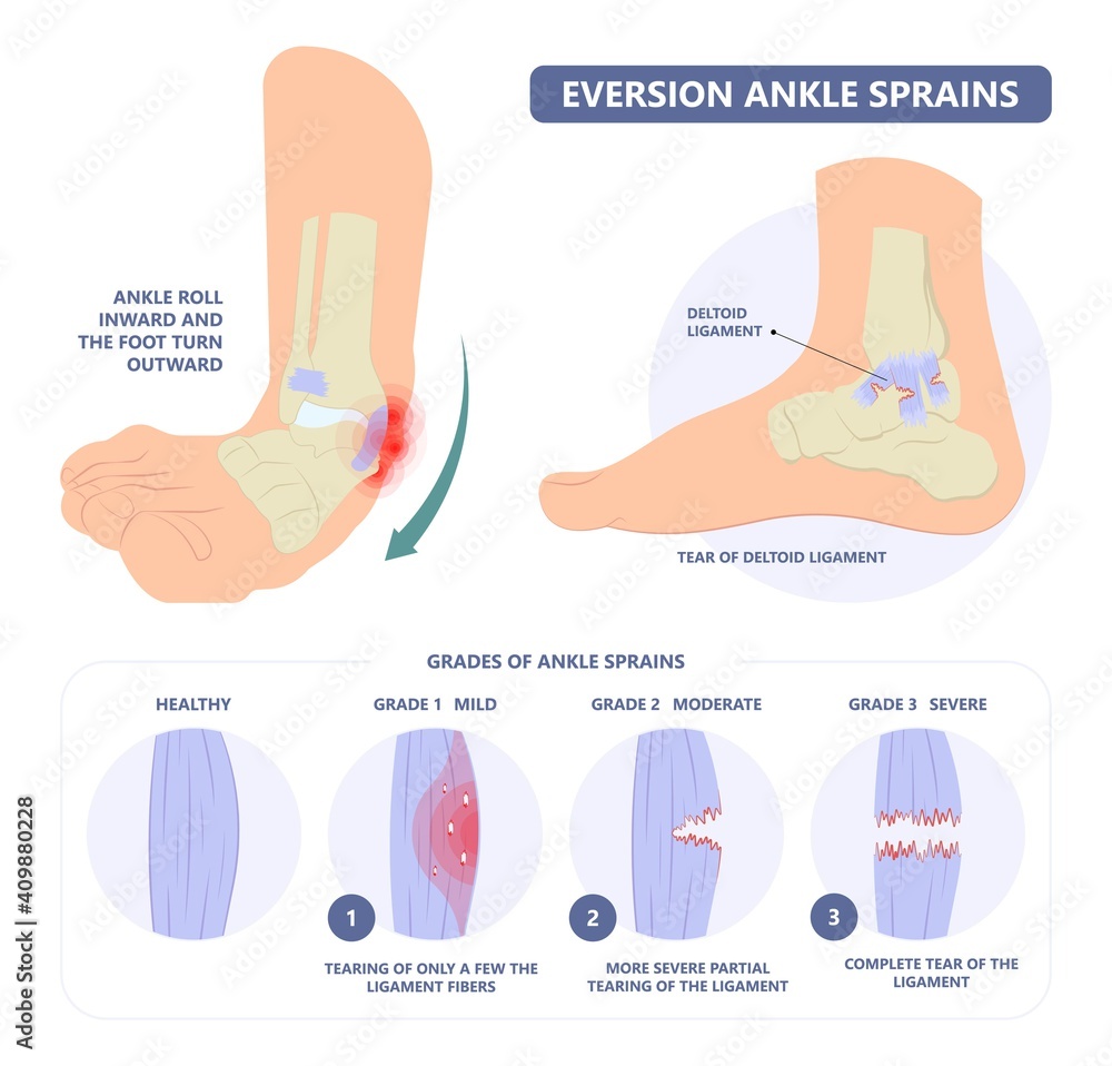 Naklejka injury Talo Fibular foot treat high low roll twist tear tough