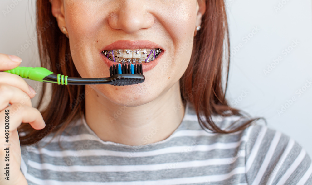 Braces in the smiling mouth of a girl. Smooth teeth from braces. Braces in the smiling mouth of a girl. Smooth teeth from braces.