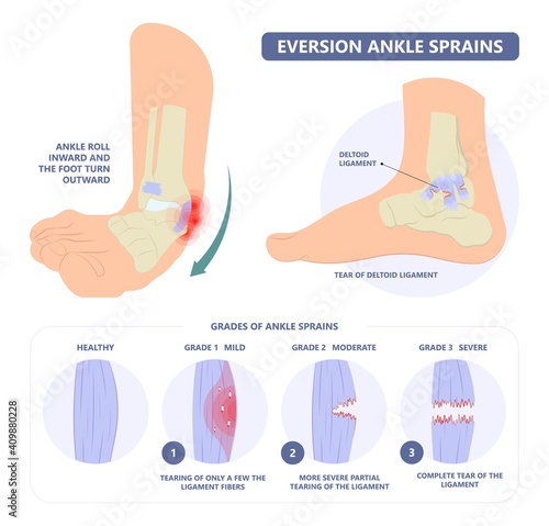 injury Talo Fibular foot treat high low roll twist tear tough bands bone joint range of motion Pain foot broken leg fall jump Walking exercising sport R.I.C.E rice Rest Ice break tendon Grade fibers