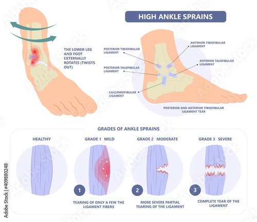 injury Talo Fibular foot treat high low roll twist tear tough bands bone joint range of motion Pain foot broken leg fall jump Walking exercising sport R.I.C.E rice Rest Ice break tendon Grade fibers