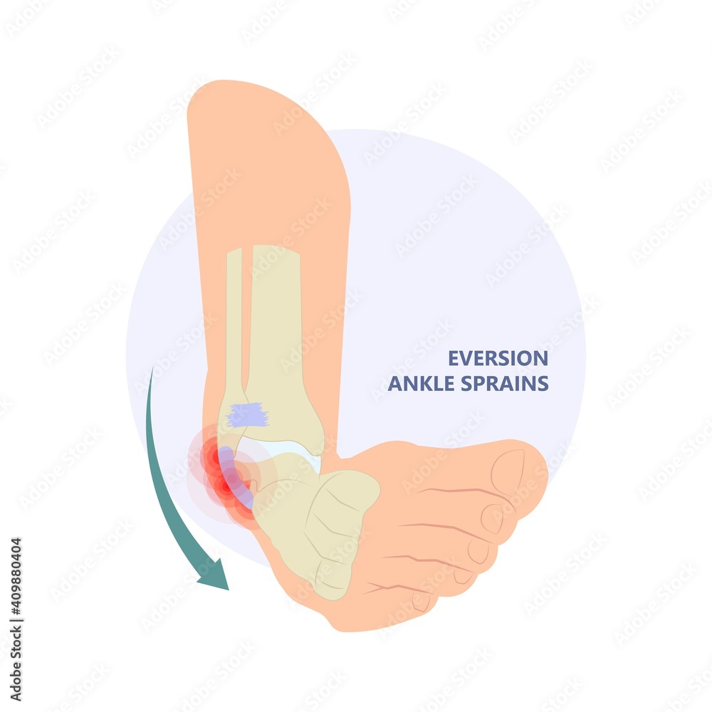injury Talo Fibular foot treat high low roll twist tear tough bands