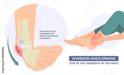 injury Talo Fibular foot treat high low roll twist tear tough bands bone joint range of motion Pain foot broken leg fall jump Walking exercising sport R.I.C.E rice Rest Ice break tendon Grade fibers