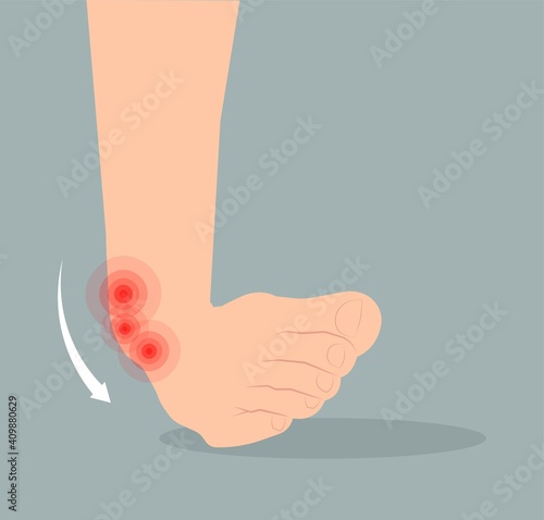injury Talo Fibular foot treat high low roll twist tear tough bands bone joint range of motion Pain foot broken leg fall jump Walking exercising sport R.I.C.E rice Rest Ice break tendon Grade fibers