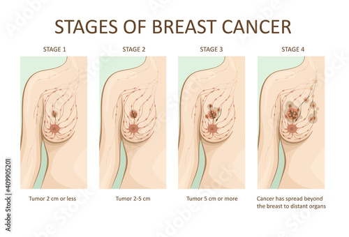 Stages of breast cancer. Medical illustration