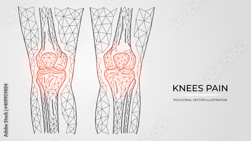 Polygonal vector illustration of pain, inflammation or injury in knees. Human legs bones anatomy. Medical orthopedic diseases templates.