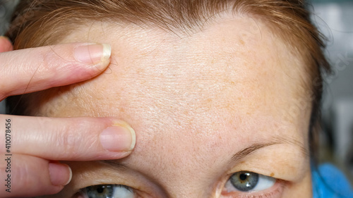 Black dots, enlarged pores on the forehead.