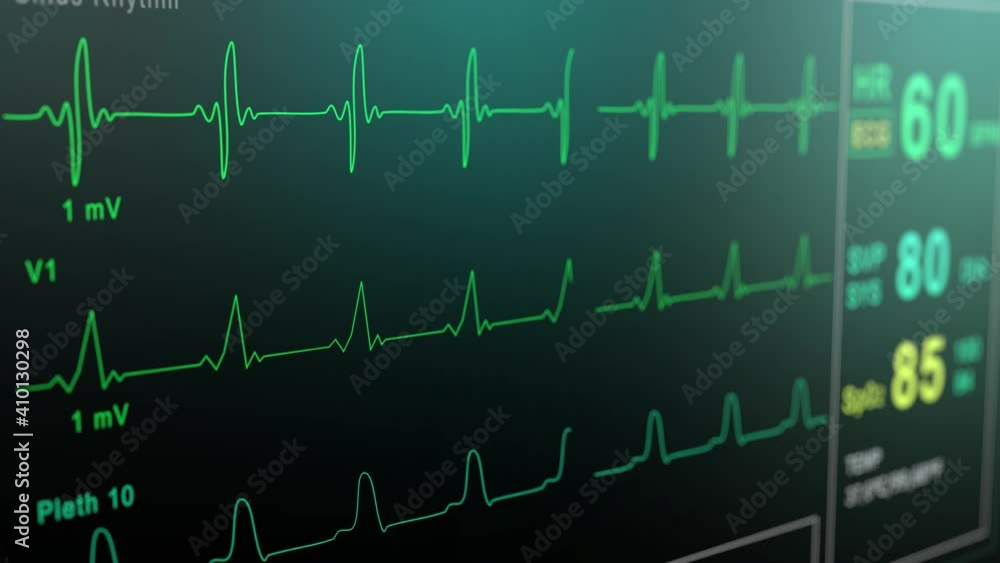 Heart rate monitor in hospital theater. Medical vital signs monitor instrument in a hospital on anesthesia surgery monitor. ECG. Patient heartbeat at the screen