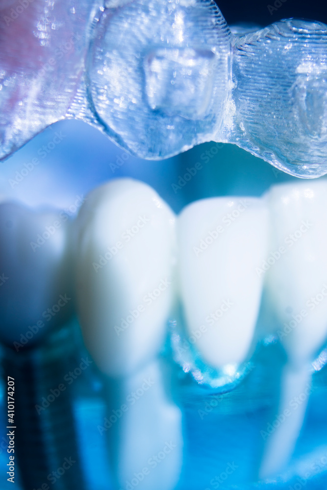 Invisible bracket aligners Invisible bracket aligners