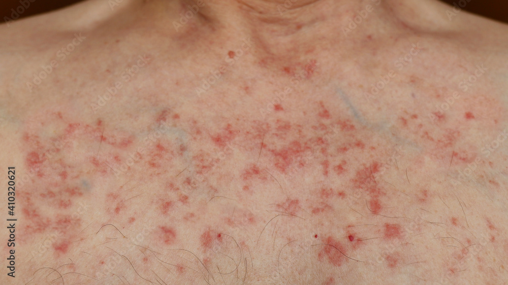 Fototapeta premium Skin reaction on a man chest after chemotherapy. Allergic reaction. Allergic rash on chest skin