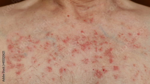 Skin reaction on a man chest after chemotherapy. Allergic reaction. Allergic rash on chest skin