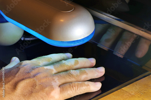 Phototherapy for skin diseases. Treatment of skin diseases such as Vitiligo, Psoriasis, and Eczema with narrow-band ultraviolet B in bright ambient light.